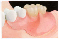 スマートデンチャー