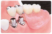 コーヌスデンチャー