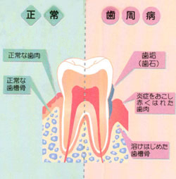 歯周病