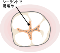 シーラントで奥歯の溝うめ