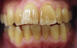 ホームホワイトニング治療前